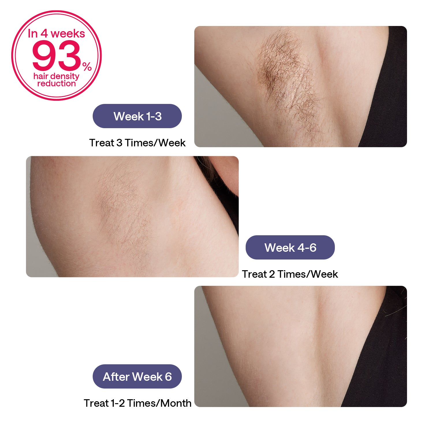 ULIKE Sapphire Air 3 IPL Hair Removal Device Without Leather Case,Purp - Default Title - Image 10